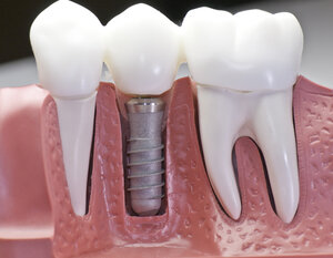 model of gums with normal teeth next to dental implant Montgomery, AL